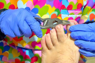 Podología especialista en pie diabético